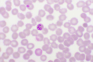 Malaria parasite in red blood cells, ring form stage of Plasmodium falciparum, original magnification 1000x